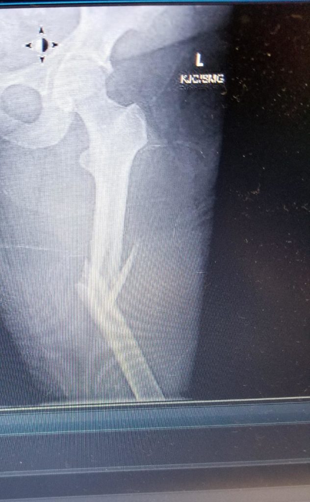 Broken Femur